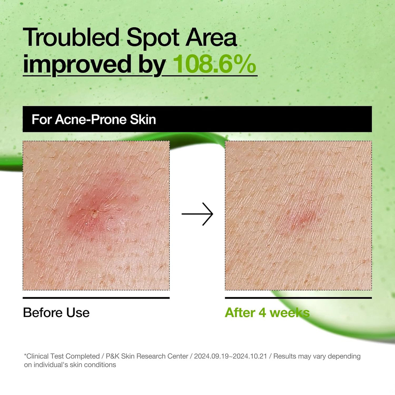 Anua Azelaic Acid 10 Hyaluron Redness Soothing Serum (1.01oz)