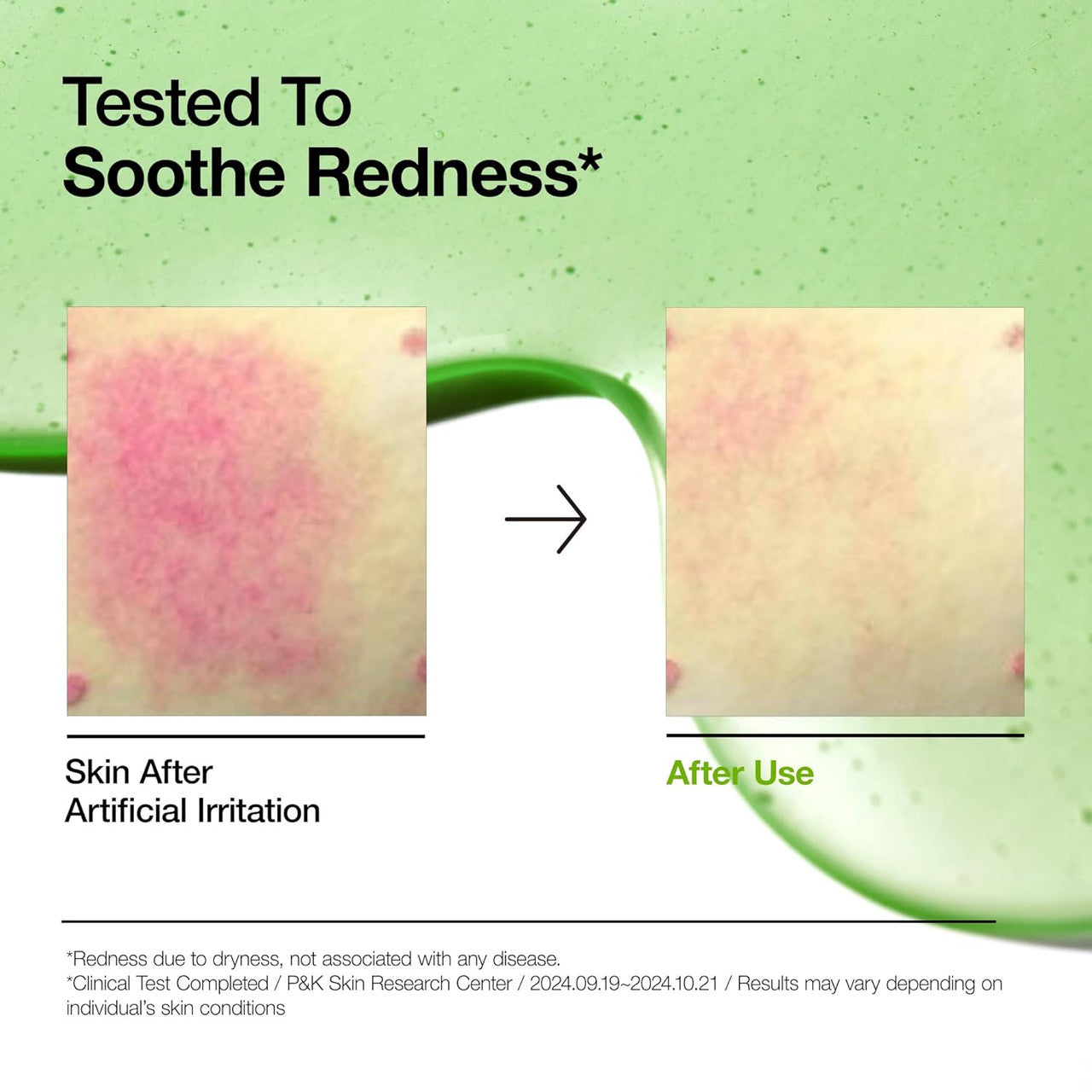 Anua Azelaic Acid 10 Hyaluron Redness Soothing Serum (1.01oz)